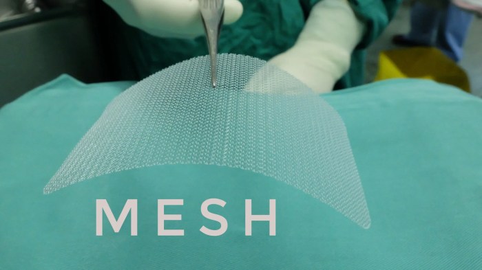 Mesh hernia lawsuits injury medical attorneys settlements lawyer Hernia mesh lawsuit attorneys near me