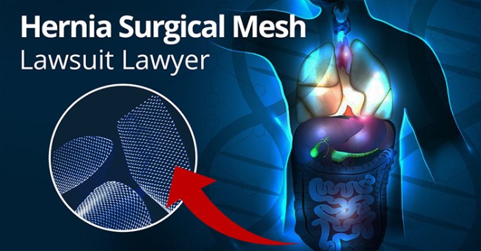 Best hernia mesh lawyers