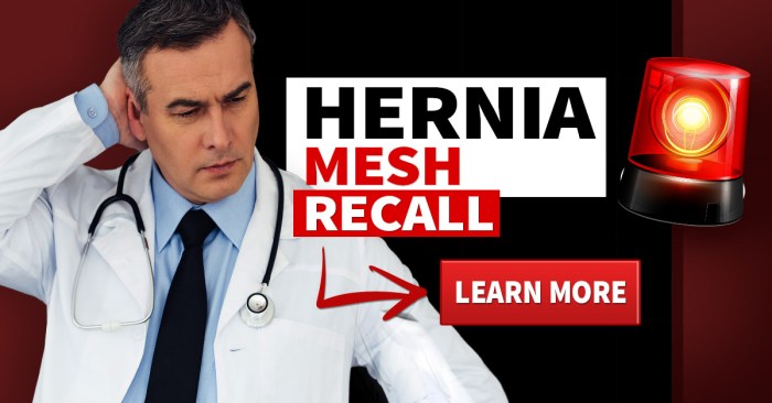 Best lawyers for hernia mesh lawsuit